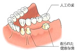 従来の入れ歯・修復物