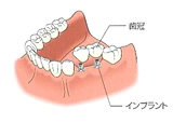 従来の入れ歯・修復物