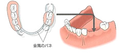 従来の入れ歯・修復物
