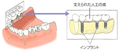 従来の入れ歯・修復物
