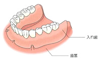 従来の入れ歯・修復物