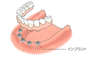 従来の入れ歯・修復物